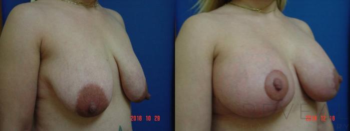 Before & After Breast Augmentation Case 300 View #3 View in San Jose, CA