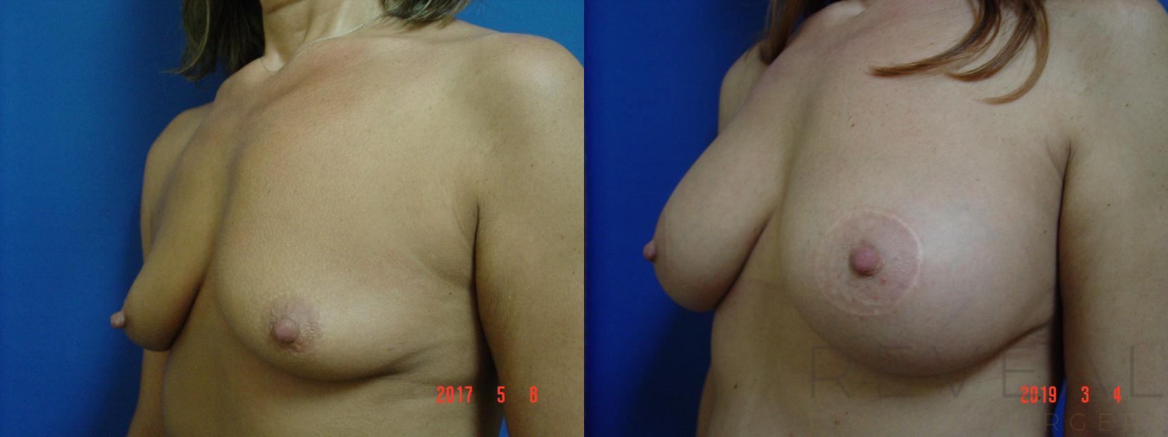 Before & After Breast Augmentation Case 311 View #1 View in San Jose, CA