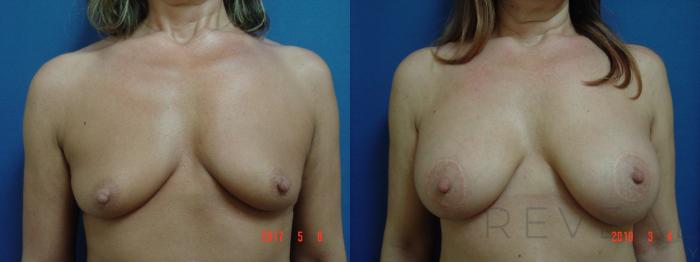 Before & After Breast Augmentation Case 311 View #3 View in San Jose, CA