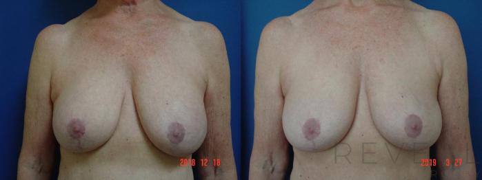 Before & After Breast Augmentation Case 322 View #1 View in San Jose, CA