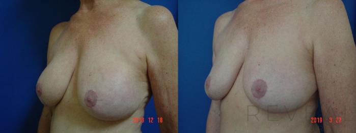 Before & After Breast Augmentation Case 322 View #2 View in San Jose, CA