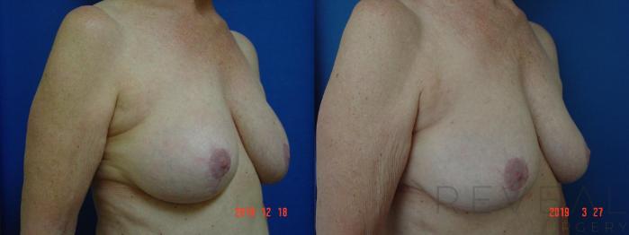 Before & After Breast Augmentation Case 322 View #3 View in San Jose, CA