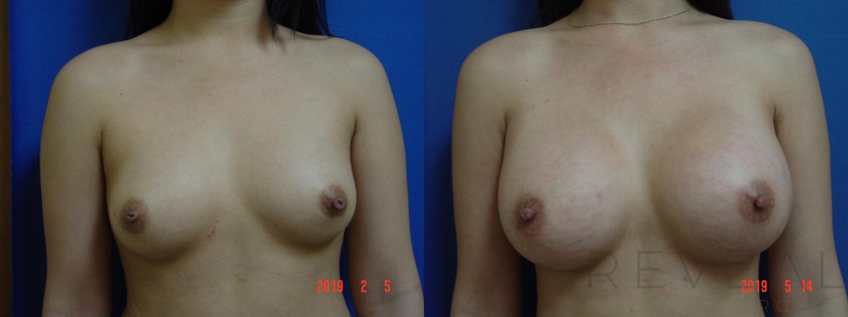 Before & After Breast Augmentation Case 334 View #1 View in San Jose, CA