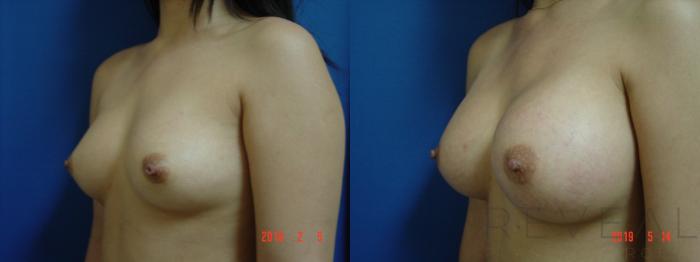 Before & After Breast Augmentation Case 334 View #2 View in San Jose, CA
