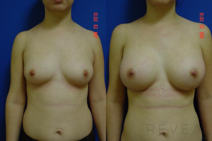 Before & After Breast Augmentation Case 36 View #1 View in San Jose, CA