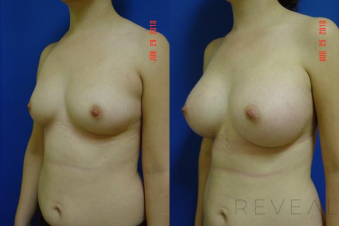 Before & After Breast Augmentation Case 36 View #2 View in San Jose, CA