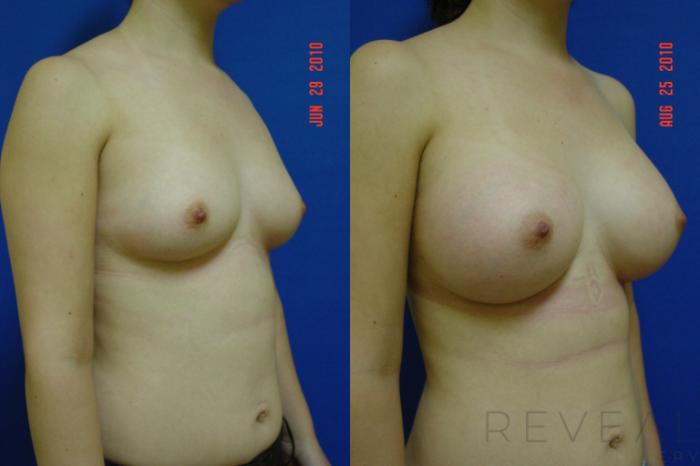 Before & After Breast Augmentation Case 36 View #4 View in San Jose, CA