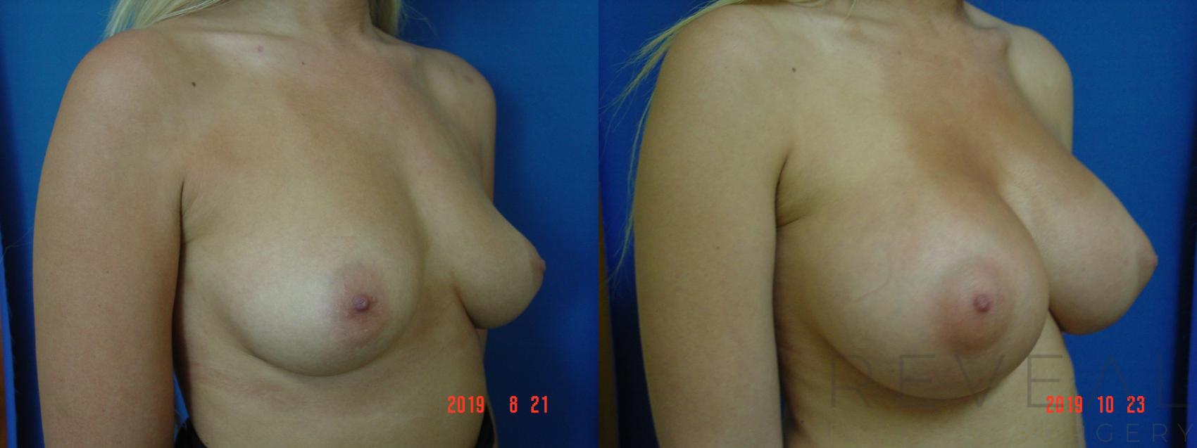 Before & After Breast Augmentation Case 368 View #1 View in San Jose, CA