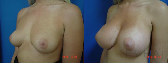 Before & After Breast Augmentation Case 368 View #3 View in San Jose, CA