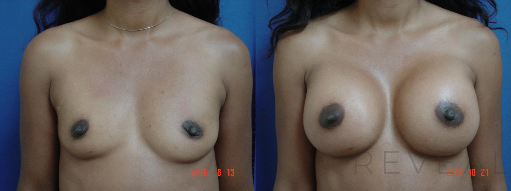 Before & After Breast Augmentation Case 369 View #1 View in San Jose, CA