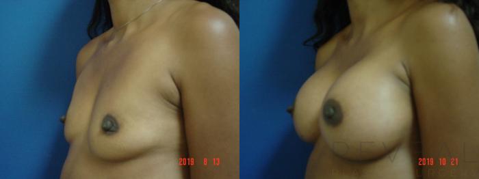 Before & After Breast Augmentation Case 369 View #2 View in San Jose, CA