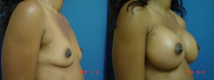 Before & After Breast Augmentation Case 369 View #3 View in San Jose, CA