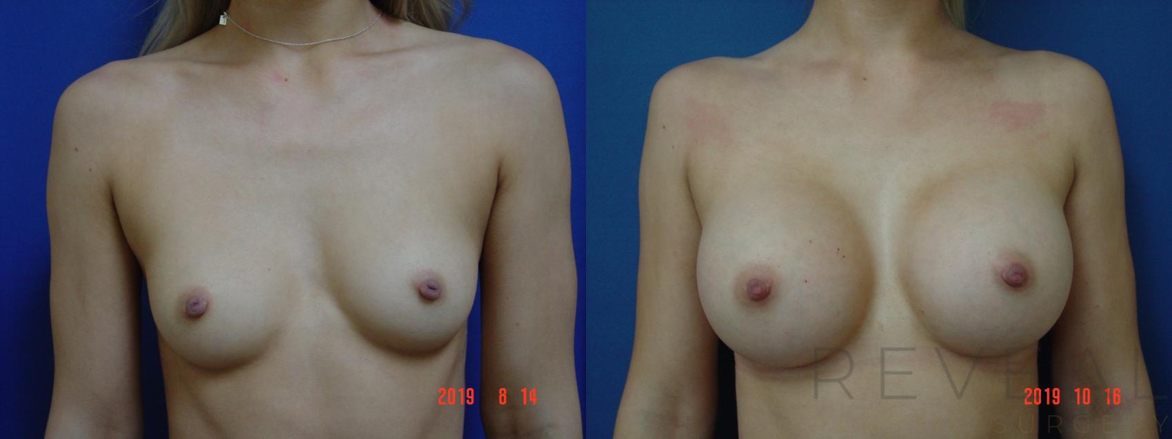 Before & After Breast Augmentation Case 371 View #1 View in San Jose, CA