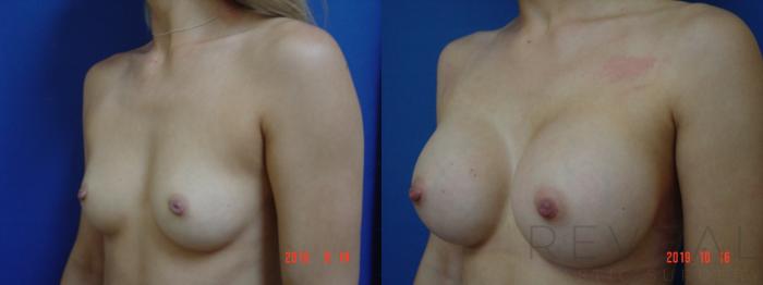 Before & After Breast Augmentation Case 371 View #2 View in San Jose, CA