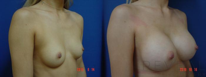 Before & After Breast Augmentation Case 371 View #3 View in San Jose, CA