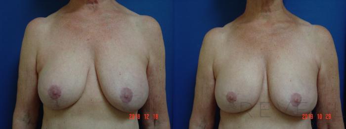 Before & After Breast Augmentation Case 372 View #1 View in San Jose, CA