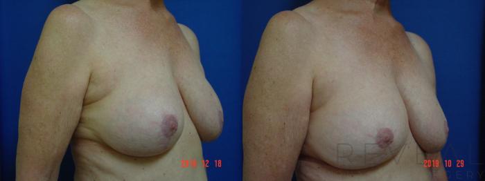Before & After Breast Augmentation Case 372 View #3 View in San Jose, CA