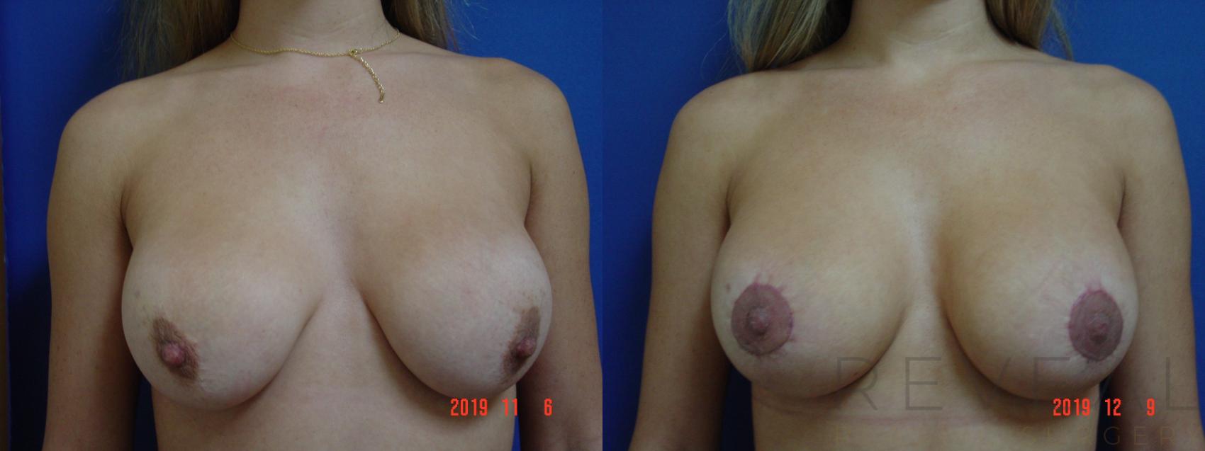 Before & After Breast Implants Case 379 View #1 View in San Jose, CA
