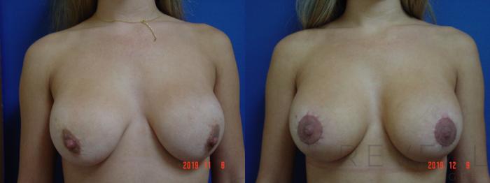 Before & After Breast Augmentation Case 379 View #1 View in San Jose, CA