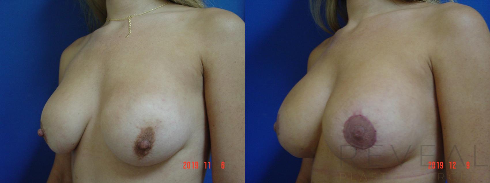Before & After Breast Lift Case 379 View #2 View in San Jose, CA