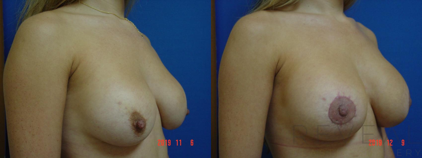 Before & After Breast Lift Case 379 View #3 View in San Jose, CA