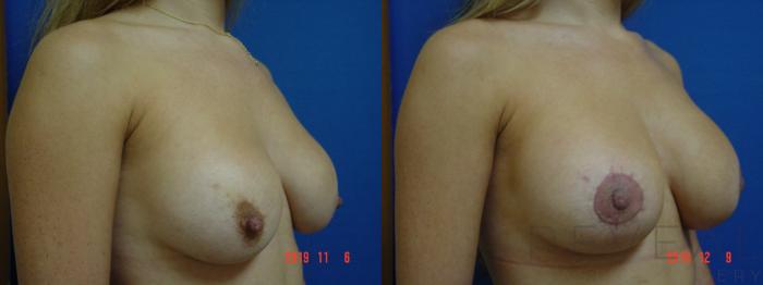 Before & After Breast Augmentation Case 379 View #3 View in San Jose, CA