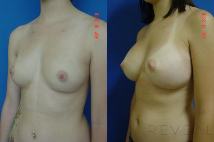 Before & After Breast Augmentation Case 38 View #1 View in San Jose, CA