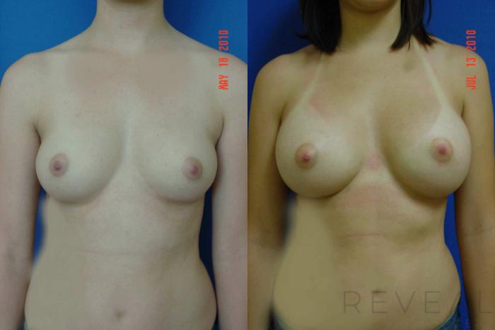 Before & After Breast Augmentation Case 38 View #3 View in San Jose, CA