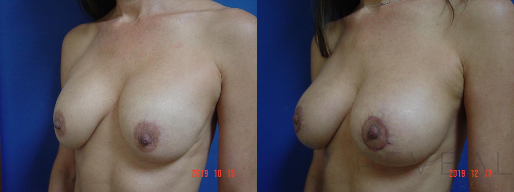 Before & After Breast Lift Case 384 View #2 View in San Jose, CA