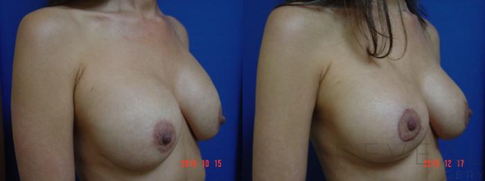 Before & After Breast Implants Case 384 View #3 View in San Jose, CA