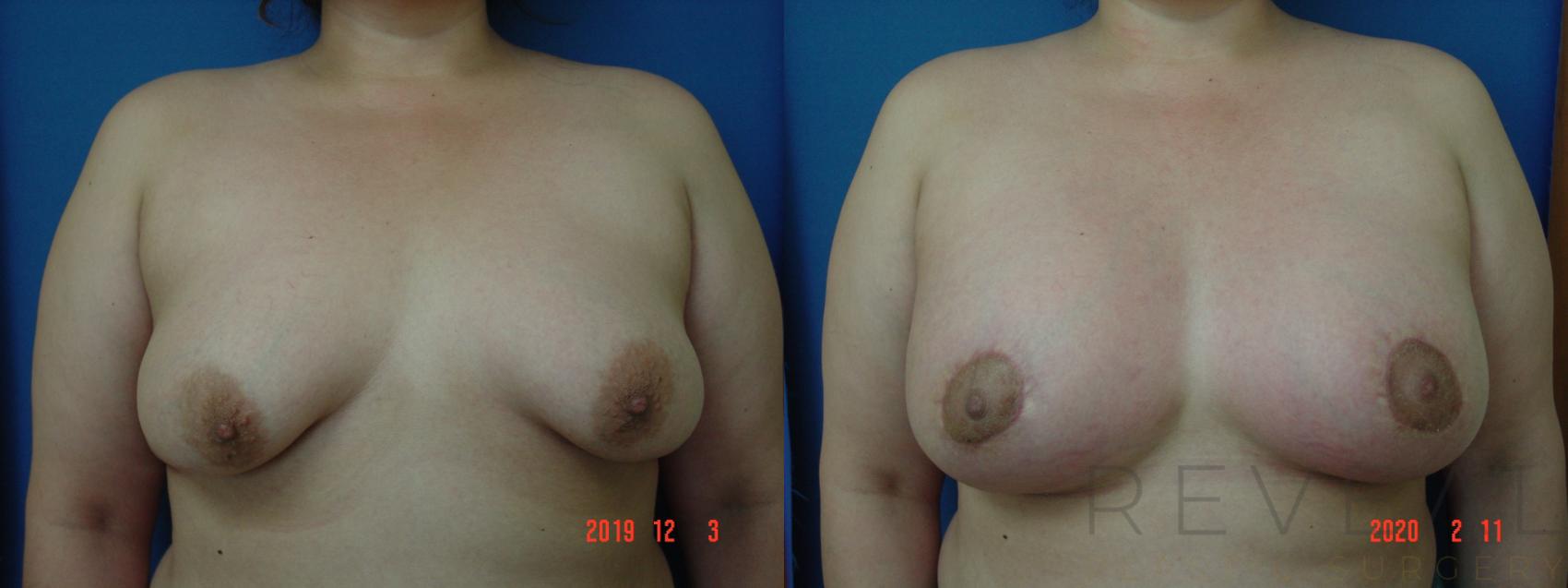 Before & After Breast Augmentation Case 393 View #1 View in San Jose, CA