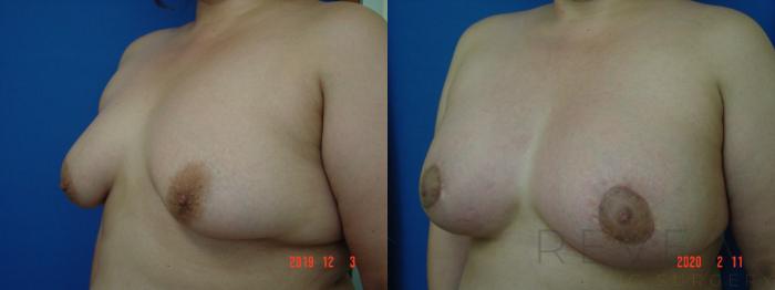Before & After Breast Augmentation Case 393 View #2 View in San Jose, CA