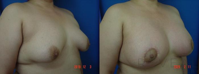 Before & After Breast Augmentation Case 393 View #3 View in San Jose, CA