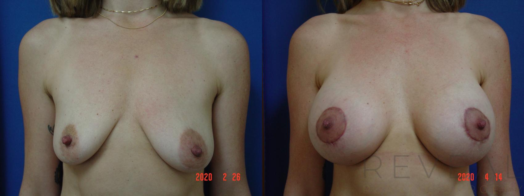 Before & After Breast Augmentation Case 397 View #1 View in San Jose, CA