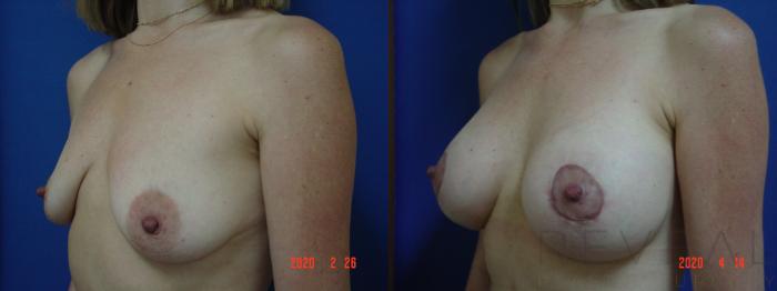 Before & After Breast Augmentation Case 397 View #2 View in San Jose, CA