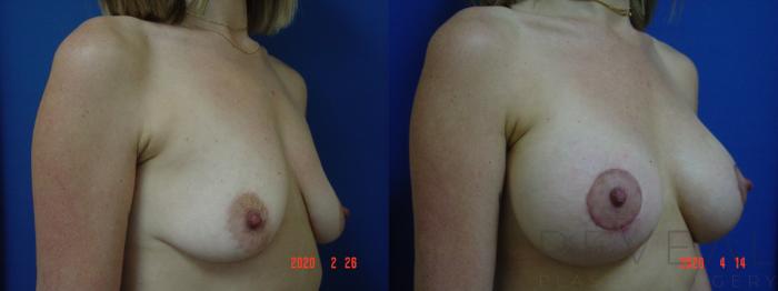 Before & After Breast Augmentation Case 397 View #3 View in San Jose, CA