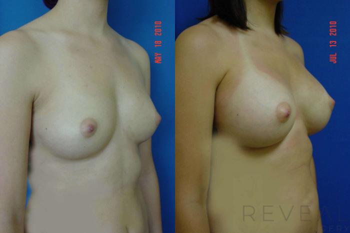 Before & After Breast Augmentation Case 40 View #3 View in San Jose, CA