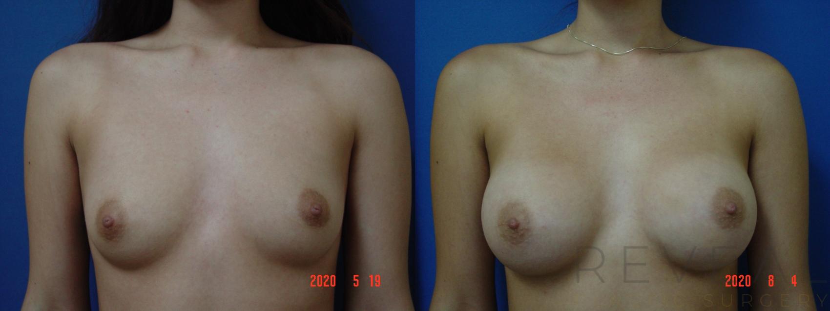 Before & After Breast Augmentation Case 402 View #1 View in San Jose, CA