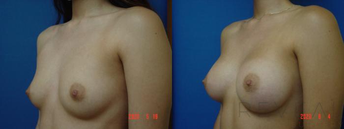 Before & After Breast Augmentation Case 402 View #2 View in San Jose, CA