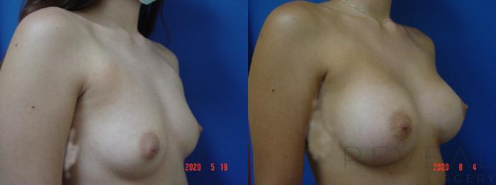 Before & After Breast Augmentation Case 402 View #3 View in San Jose, CA
