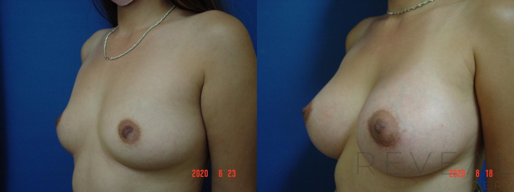 Before & After Breast Augmentation Case 403 View #1 View in San Jose, CA