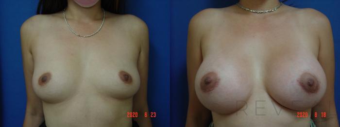 Before & After Breast Augmentation Case 403 View #2 View in San Jose, CA