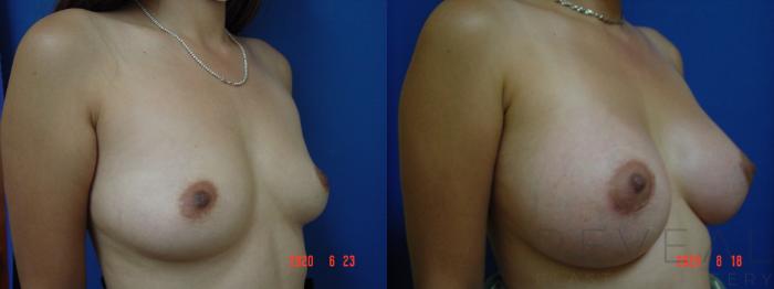 Before & After Breast Augmentation Case 403 View #3 View in San Jose, CA