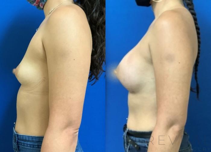 Before & After Breast Augmentation Case 404 View #1 View in San Jose, CA