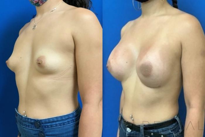 Before & After Breast Augmentation Case 404 View #2 View in San Jose, CA