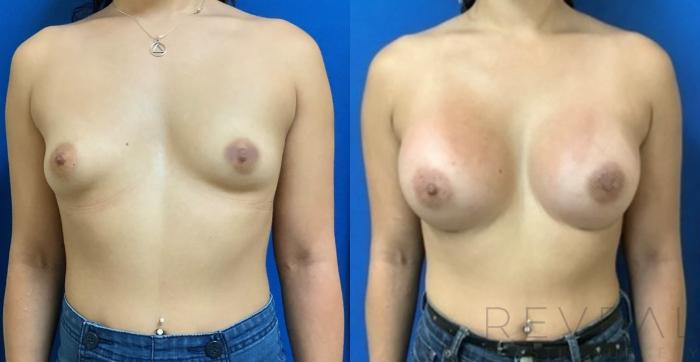 Before & After Breast Augmentation Case 404 View #3 View in San Jose, CA