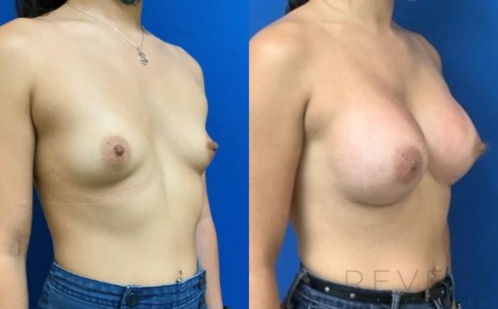 Before & After Breast Augmentation Case 404 View #4 View in San Jose, CA