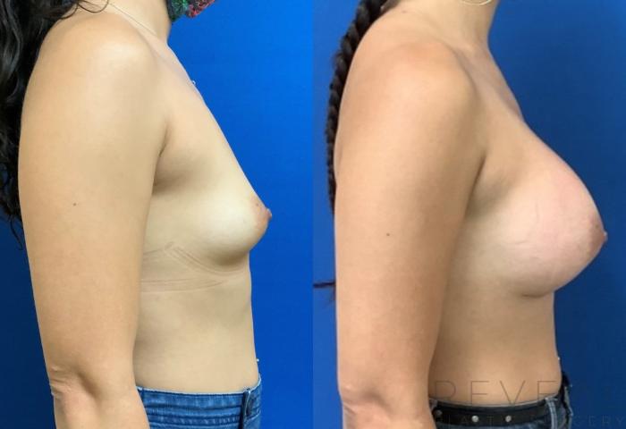 Before & After Breast Augmentation Case 404 View #5 View in San Jose, CA