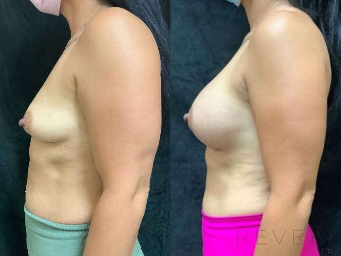 Before & After Breast Augmentation Case 405 View #3 View in San Jose, CA