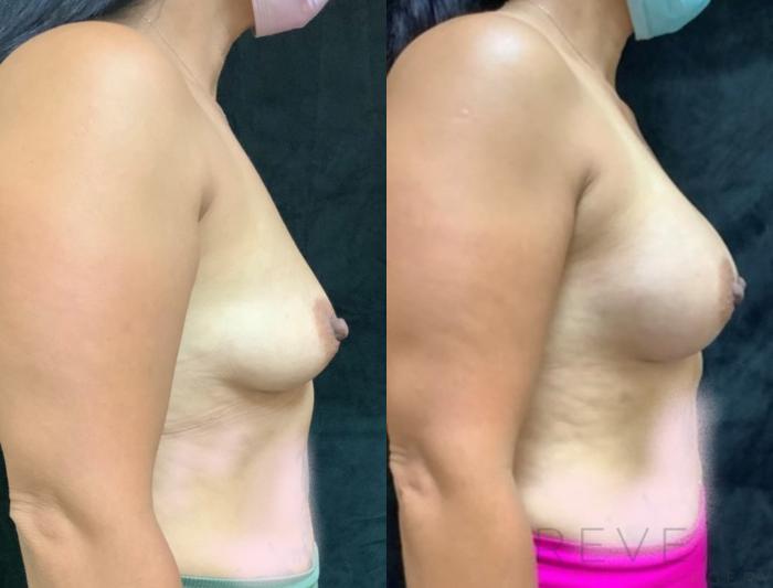 Before & After Breast Augmentation Case 405 View #4 View in San Jose, CA